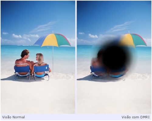 Comparação entre Visão Normal e Visão com DMRI